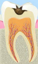 C2：象牙質の虫歯