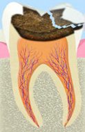 C3：神経に達した虫歯