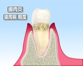 軽度の歯周病