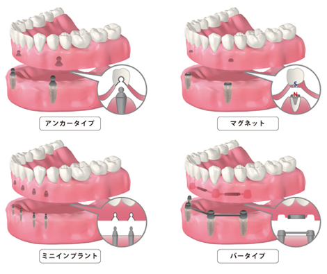 インプラントオーバーデンチャー